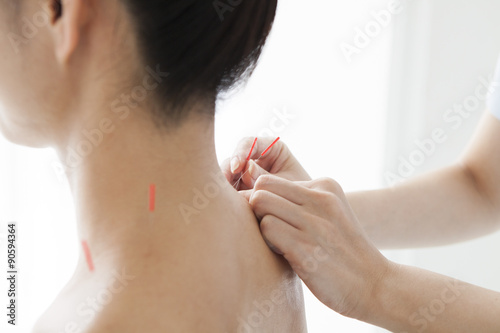 Acupuncturist is treating a woman's shoulder