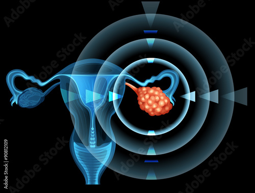 Cancer in ovary of woman