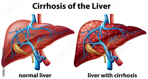 Cirrhosis of the liver poster photo