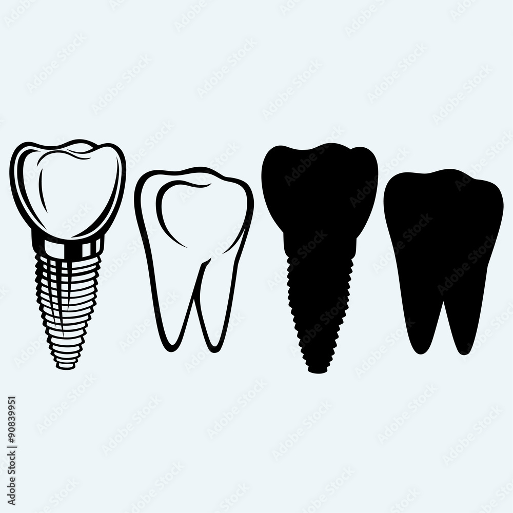 Tooth implant and molar. Isolated on blue background Tooth implant and molar. Isolated on blue background