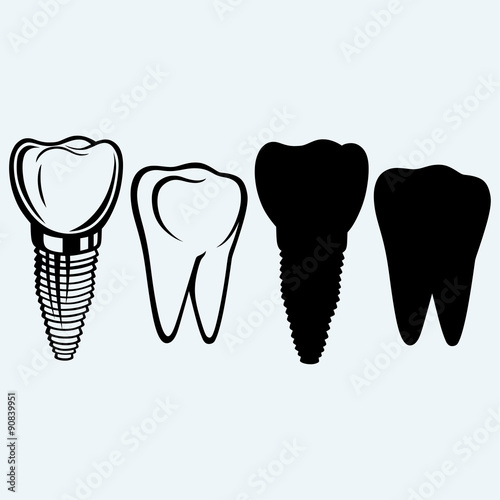 Tooth implant and molar. Isolated on blue background