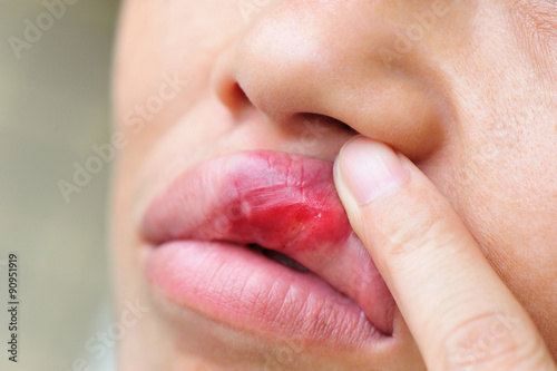 people show upper lip of the mouth with injury photo