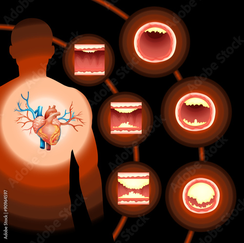 Heart cholesterol in human body photo