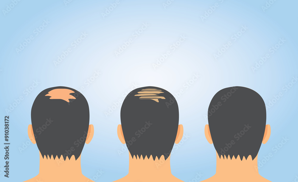 The Increase hair volume after hair fall treatment on bald Stock Vector | Adobe Stock The Increase hair volume after hair fall treatment on bald Stock Vector | Adobe Stock