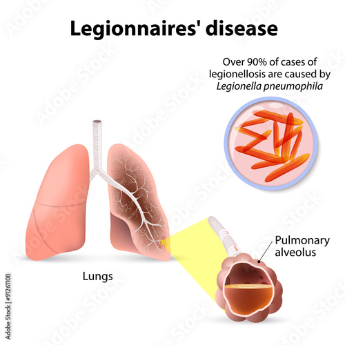 Legionnaires' disease or legionellosis, Legion fever is a form o