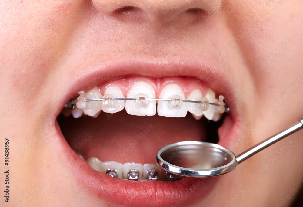 Fototapeta premium Teeth with orthodontic brackets.