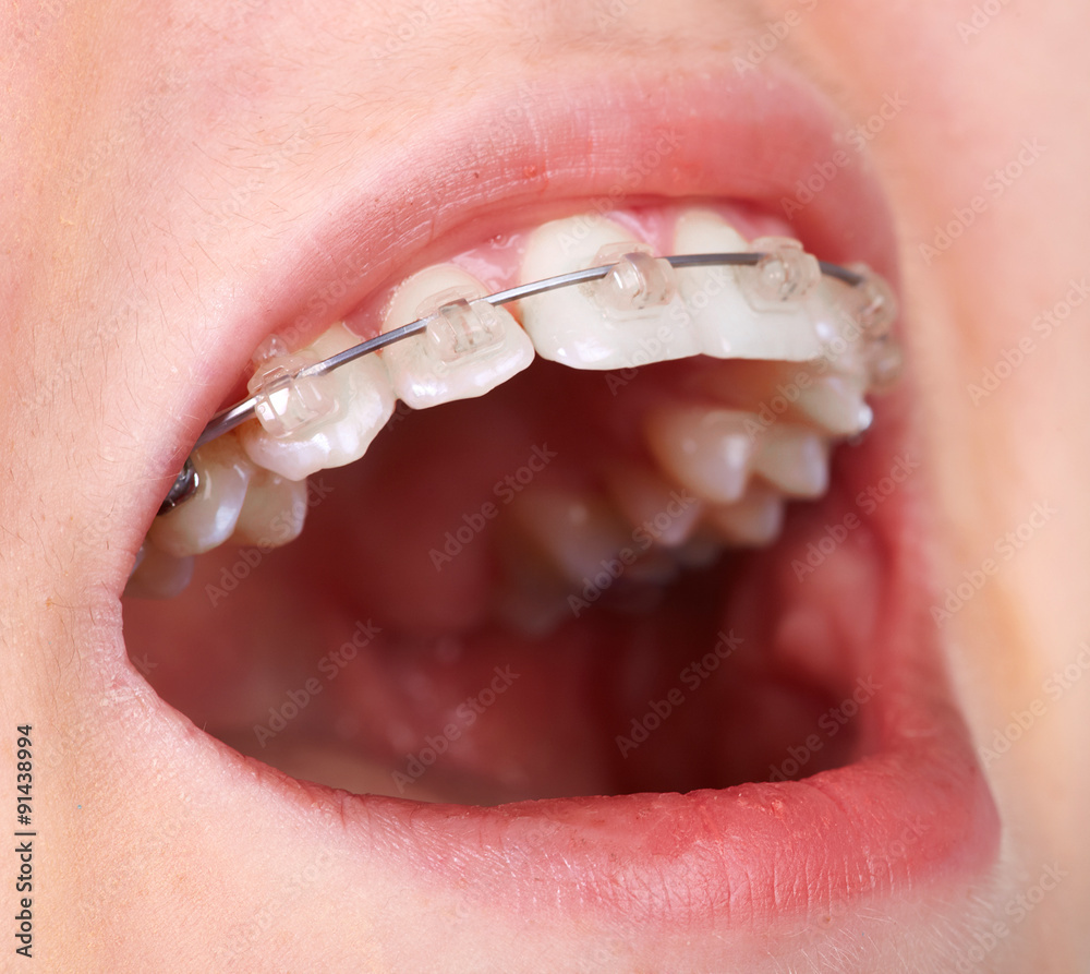 Fototapeta premium Teeth with orthodontic brackets.