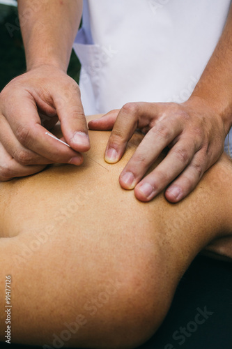 Physiotherapist doing a dry puncture
