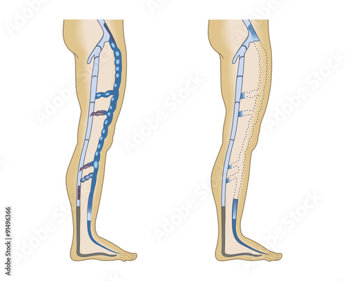 illustration leg veins on a white background