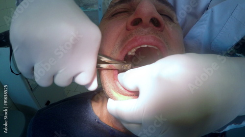 4K Tooth extraction. Dentist pulls the tooth out. Preparation for implants. UHD stock footage photo