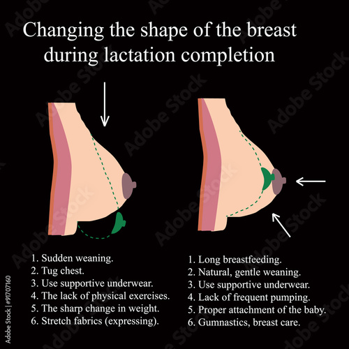 Changing the shape of the breast during lactation completion.