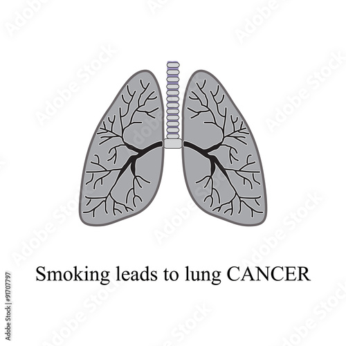 Smoking leads to lung cancer. Vector illustration on isolated