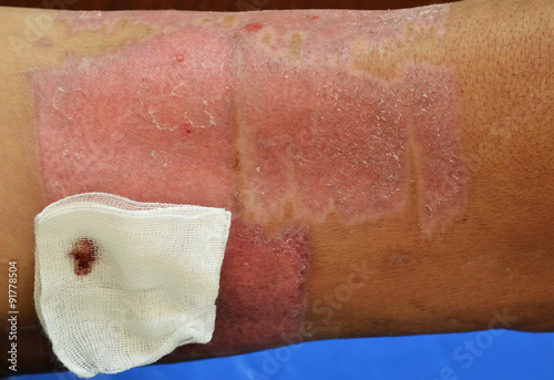 Tableau sur toile Skin graft wound.