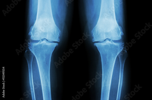Osteoarthritis Knee ( OA Knee ). Film x-ray both knee ( front view ) show narrow joint space ( joint cartilage loss ) , osteophyte , subchondral sclerosis © stockdevil