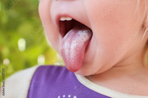 Fotografie, Obraz White coating on tongue baby. Oral thrush.