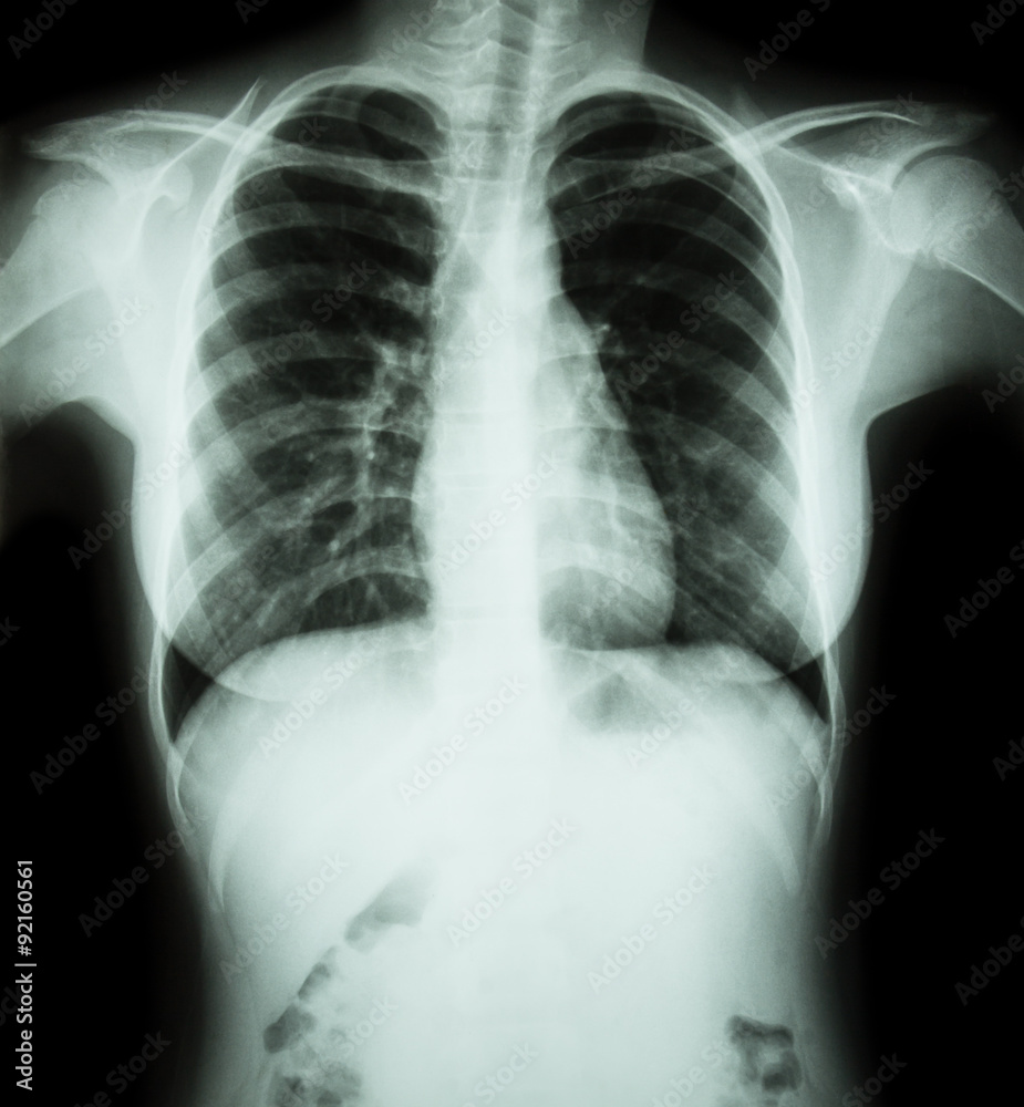 Film chest x-ray : show normal chest of woman Film chest x-ray : show normal chest of woman