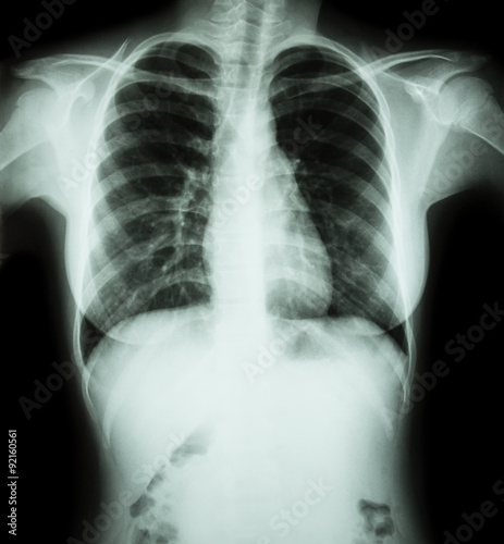 Film chest x-ray : show normal chest of woman