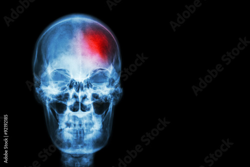 Stroke ( Cerebrovascular accident ) . film x-ray skull of human with red area ( Medical , Science and Healthcare concept and background )