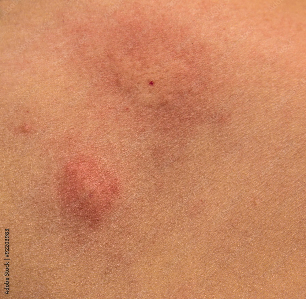 Fototapeta premium Mosquito Bite