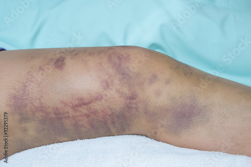 Closeup on a Bruise on wounded woman leg skin photo