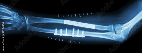 Fracture both bone of forearm ( ulnar and radius ) .  It was operated and internal fixed by plate and screw photo