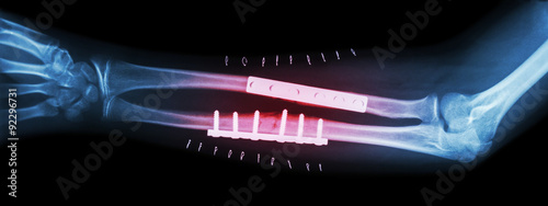 Fotografie Fracture both bone of forearm ( ulnar and radius )