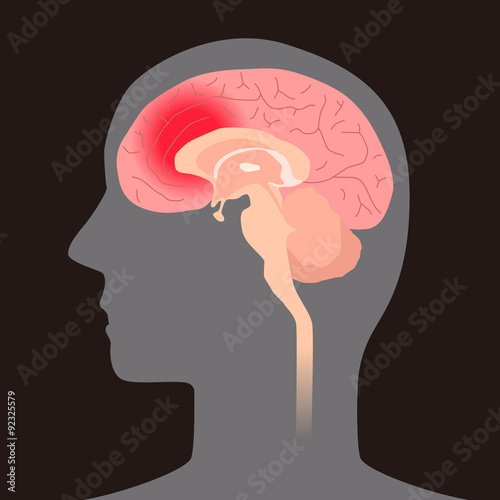 cerebral hemorrhage, image illustration