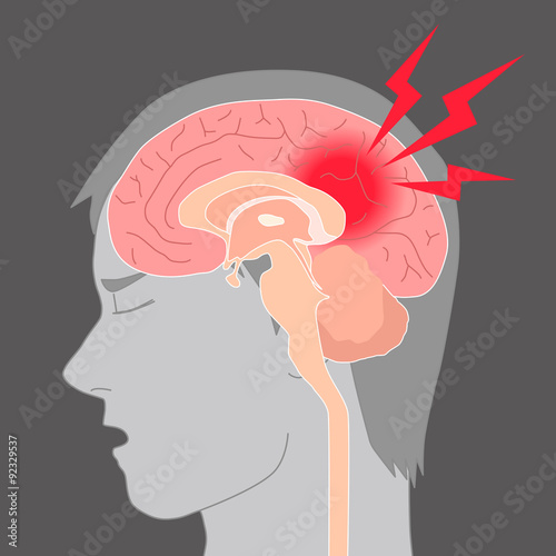 headache, cerebral hemorrhage, brain stroke, image illustration