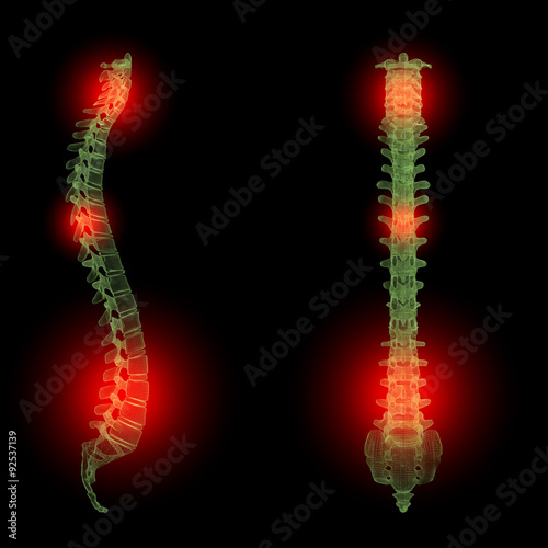 Schmerzen in der Wirbelsäule, medizinische Illustration