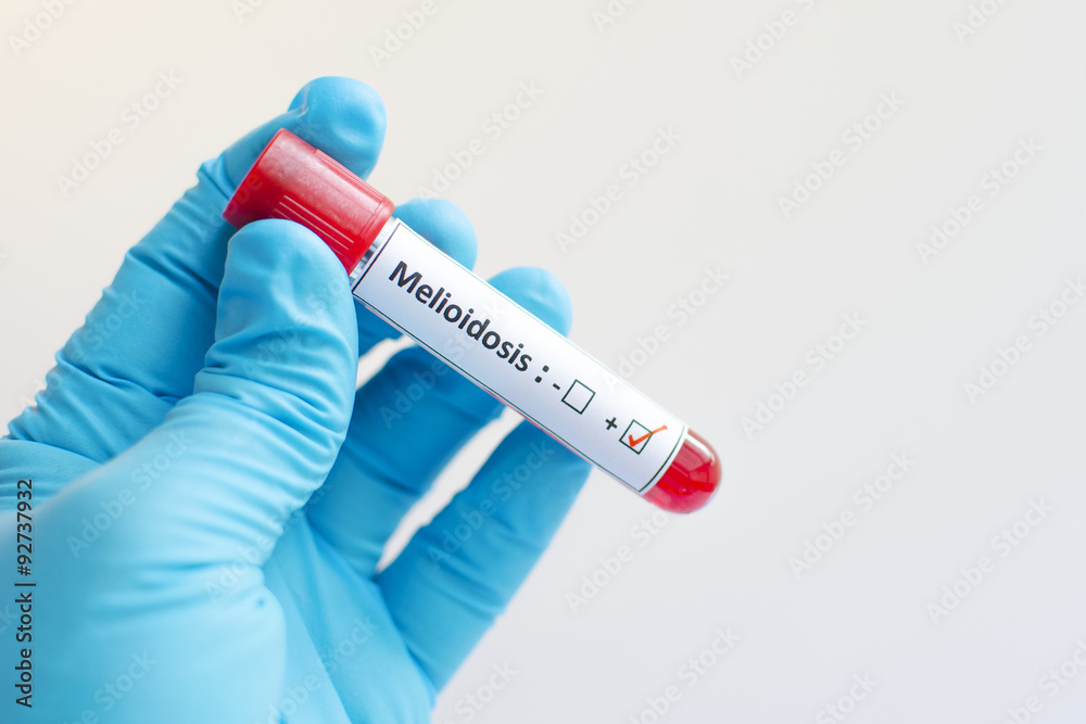 Obraz premium Melioidosis positive
