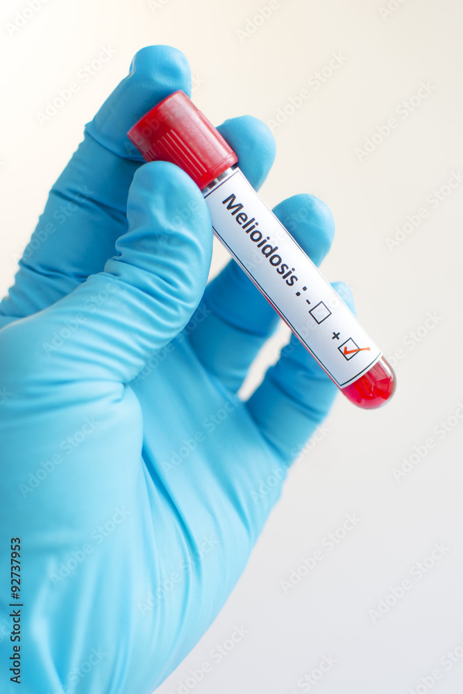 Obraz premium Melioidosis positive