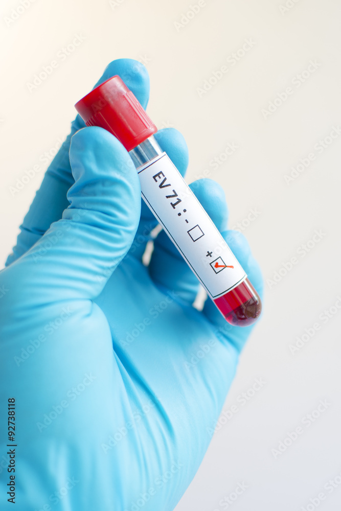 Fototapeta premium Enterovirus 71 (EV 71) positive