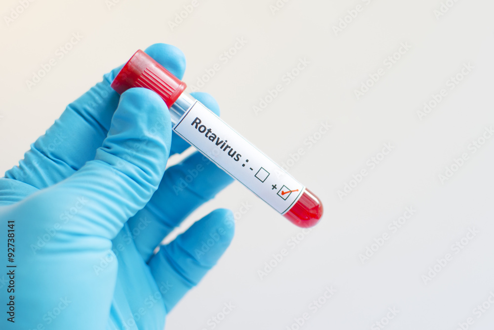 Obraz premium Rotavirus blood sample