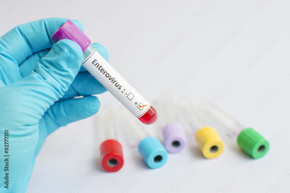 Fototapeta premium Enterovirus blood sample