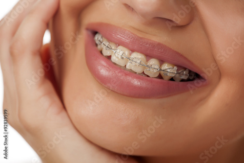 smiling female mouth with braces on her teeth