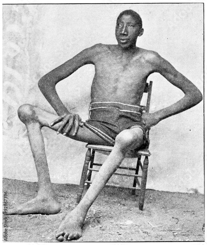 Acromegaly, vintage engraving. photo