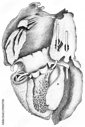 Heart showing villous pericarditis, vintage engraving. photo