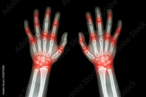 Rheumatoid arthritis , Gout arthritis  ( Film x-ray both hands of child with multiple joint arthritis ) ( Medical , Science and Health care concept ) photo