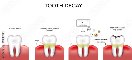 Tooth decay formation