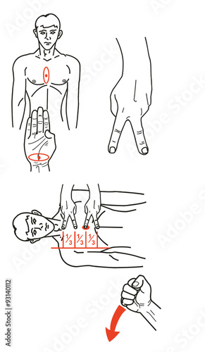 First Aid, indirect heart massage