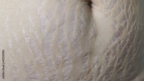 Closeup stretch mark on post pregnant woman belly 