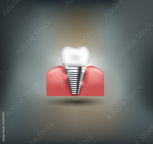 Dental implant