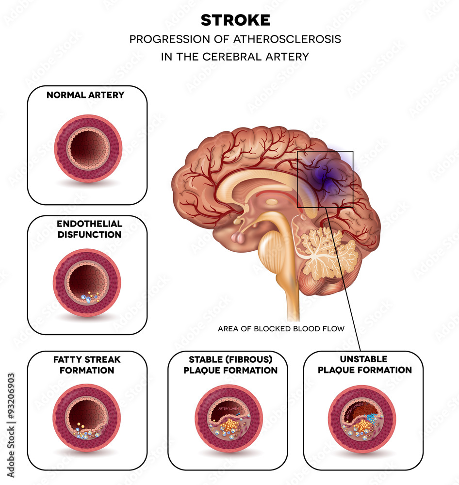 Stroke in the brain artery Stroke in the brain artery