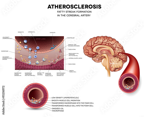 Atherosclerosis. Fatty streak formation in the brain