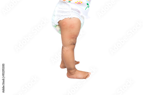 new born with multiple mosquito bites on leg, white background,w