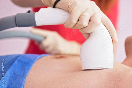 male laser epilation