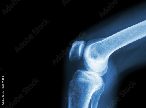 Film x-ray knee joint with arthritis ( Gout , Rheumatoid arthritis , Septic arthritis , Osteoarthritis knee ) and blank area at left side