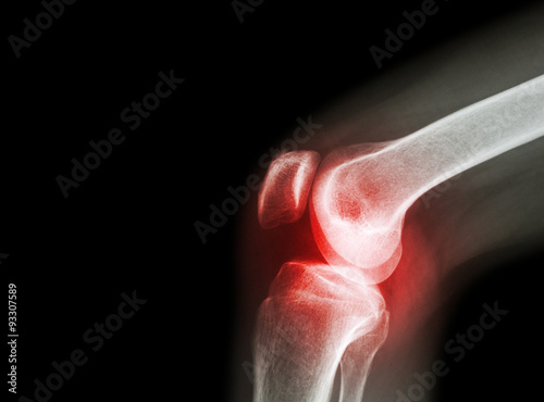 Film x-ray knee joint with arthritis ( Gout , Rheumatoid arthritis , Septic arthritis , Osteoarthritis knee ) and blank area at left side photo