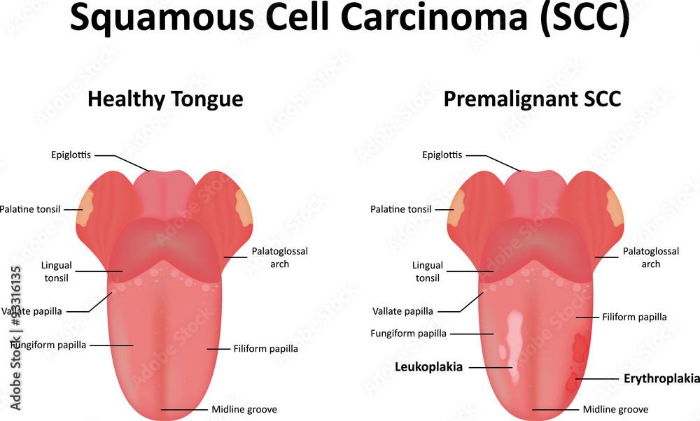 squamous-cell-carcinoma-of-the-tongue-stock-vector-adobe-stock