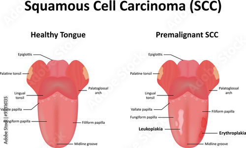 Squamous Cell Carcinoma of the Tongue